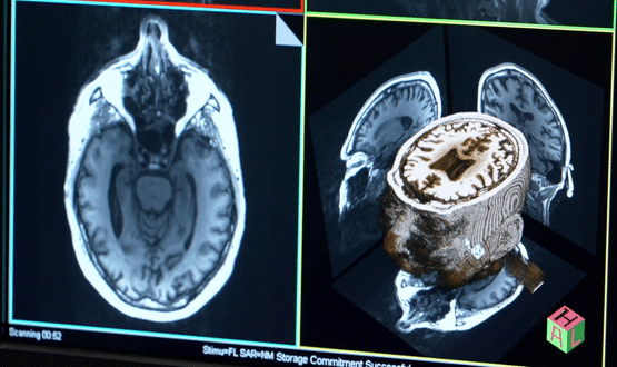 Addenbrooke’s Hospital trials AI to help speed up dementia diagnosis