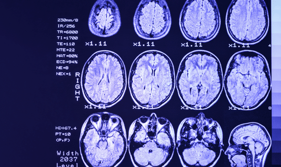 Visionable & SameYou announce partnership to improve & innovate brain rehabilitation and recovery